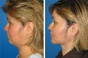 Before & After Photos